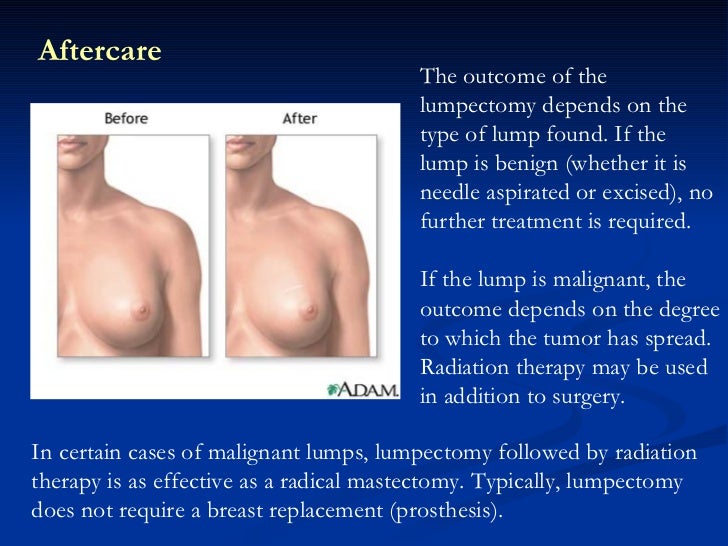 hard lump in breast after excision Short teen hair styles